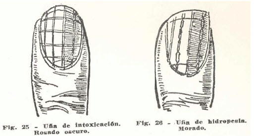 10-una-hidropesia