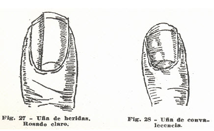 11-una-heridas