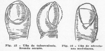 5-una-tuberculosis