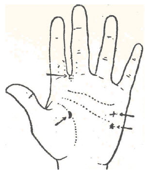 56-gota-articular