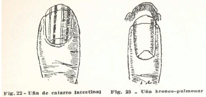 8-una-catarro