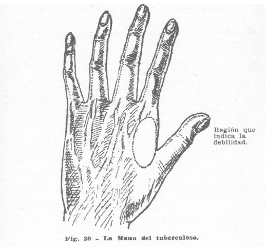 mano-tuberculoso