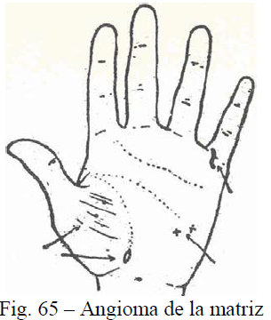 f65-angioma-matriz