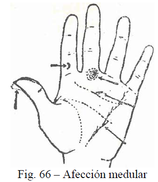 f66-afeccion-medular