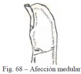 f68-afeccion-medular